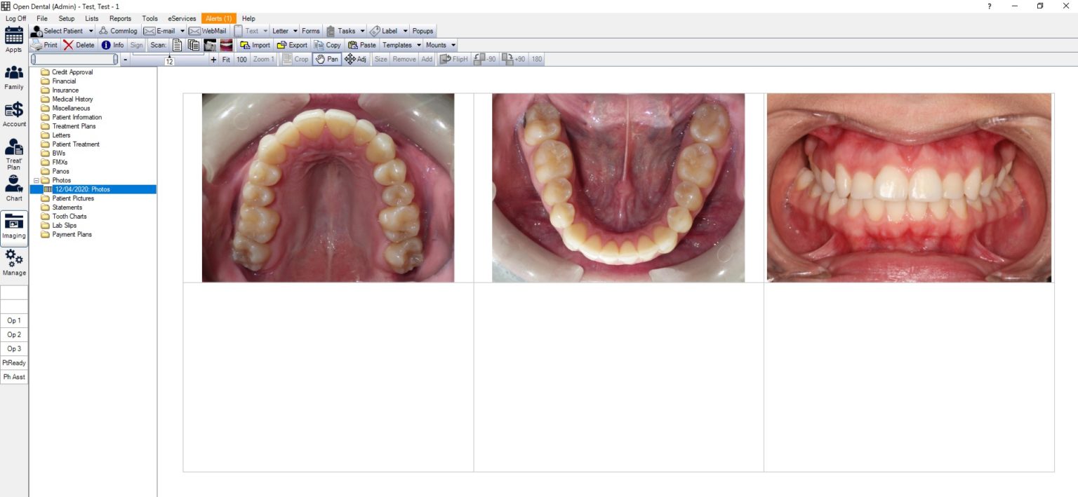 open dental tutorial